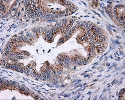TLDC1 / KIAA1609 Antibody - IHC of paraffin-embedded Adenocarcinoma of Human colon tissue using anti-KIAA1609 mouse monoclonal antibody.
