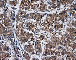 TLDC1 / KIAA1609 Antibody - IHC of paraffin-embedded Carcinoma of Human liver tissue using anti-KIAA1609 mouse monoclonal antibody.