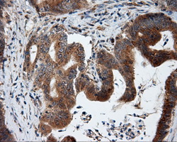 TLDC1 / KIAA1609 Antibody - IHC of paraffin-embedded Adenocarcinoma of colon tissue using anti-KIAA1609 mouse monoclonal antibody. (Dilution 1:50).
