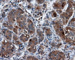 TLDC1 / KIAA1609 Antibody - IHC of paraffin-embedded Carcinoma of liver tissue using anti-KIAA1609 mouse monoclonal antibody. (Dilution 1:50).