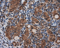 TLDC1 / KIAA1609 Antibody - IHC of paraffin-embedded Carcinoma of thyroid tissue using anti-KIAA1609 mouse monoclonal antibody. (Dilution 1:50).