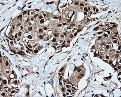 TLDC1 / KIAA1609 Antibody - IHC of paraffin-embedded Adenocarcinoma of breast tissue using anti-KIAA1609 mouse monoclonal antibody. (Dilution 1:50).