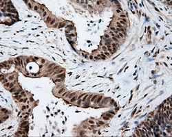 TLDC1 / KIAA1609 Antibody - IHC of paraffin-embedded Adenocarcinoma of colon tissue using anti-KIAA1609 mouse monoclonal antibody. (Dilution 1:50).