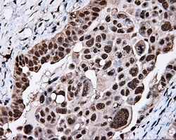 TLDC1 / KIAA1609 Antibody - IHC of paraffin-embedded Adenocarcinoma of ovary tissue using anti-KIAA1609 mouse monoclonal antibody. (Dilution 1:50).