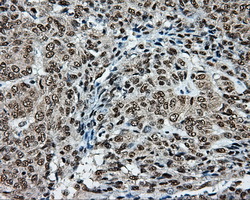 TLDC1 / KIAA1609 Antibody - IHC of paraffin-embedded Adenocarcinoma of endometrium tissue using anti-KIAA1609 mouse monoclonal antibody. (Dilution 1:50).