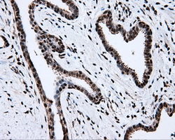 TLDC1 / KIAA1609 Antibody - IHC of paraffin-embedded Carcinoma of prostate tissue using anti-KIAA1609 mouse monoclonal antibody. (Dilution 1:50).
