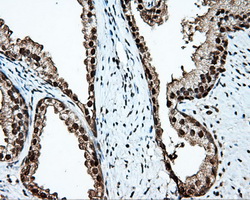 TLDC1 / KIAA1609 Antibody - IHC of paraffin-embedded prostate tissue using anti-KIAA1609 mouse monoclonal antibody. (Dilution 1:50).