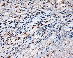 TLDC1 / KIAA1609 Antibody - IHC of paraffin-embedded Carcinoma of bladder tissue using anti-KIAA1609 mouse monoclonal antibody. (Dilution 1:50).
