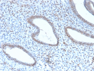 TLE1 / TLE 1 Antibody - Formalin-fixed, paraffin-embedded Human Endometrial Carcinoma stained with TLE1 Rabbit Recombinant Monoclonal Antibody (TLE1/2946R).