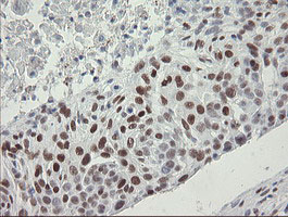 TLE1 / TLE 1 Antibody - IHC of paraffin-embedded Carcinoma of Human lung tissue using anti-TLE1 mouse monoclonal antibody. (Heat-induced epitope retrieval by 10mM citric buffer, pH6.0, 100C for 10min).