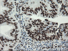 TLE1 / TLE 1 Antibody - IHC of paraffin-embedded Adenocarcinoma of Human endometrium tissue using anti-TLE1 mouse monoclonal antibody. (Heat-induced epitope retrieval by 10mM citric buffer, pH6.0, 100C for 10min).
