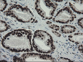 TLE1 / TLE 1 Antibody - IHC of paraffin-embedded Carcinoma of Human prostate tissue using anti-TLE1 mouse monoclonal antibody. (Heat-induced epitope retrieval by 10mM citric buffer, pH6.0, 100C for 10min).