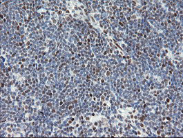 TLE1 / TLE 1 Antibody - IHC of paraffin-embedded Human lymphoma tissue using anti-TLE1 mouse monoclonal antibody. (Heat-induced epitope retrieval by 10mM citric buffer, pH6.0, 100C for 10min).