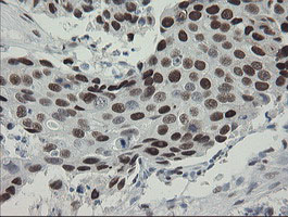 TLE1 / TLE 1 Antibody - IHC of paraffin-embedded Adenocarcinoma of Human breast tissue using anti-TLE1 mouse monoclonal antibody. (Heat-induced epitope retrieval by 10mM citric buffer, pH6.0, 100C for 10min).