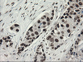 TLE1 / TLE 1 Antibody - IHC of paraffin-embedded Adenocarcinoma of Human breast tissue using anti-TLE1 mouse monoclonal antibody.