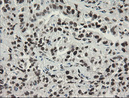 TLE1 / TLE 1 Antibody - IHC of paraffin-embedded Carcinoma of Human kidney tissue using anti-TLE1 mouse monoclonal antibody.