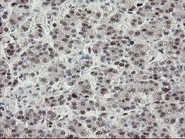 TLE1 / TLE 1 Antibody - IHC of paraffin-embedded Carcinoma of Human liver tissue using anti-TLE1 mouse monoclonal antibody.