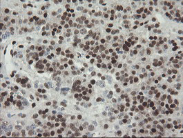 TLE1 / TLE 1 Antibody - IHC of paraffin-embedded Carcinoma of Human pancreas tissue using anti-TLE1 mouse monoclonal antibody.
