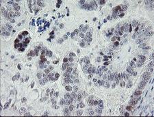 TLE1 / TLE 1 Antibody - IHC of paraffin-embedded Adenocarcinoma of Human ovary tissue using anti-TLE1 mouse monoclonal antibody. (Heat-induced epitope retrieval by 10mM citric buffer, pH6.0, 100C for 10min).