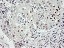 TLE1 / TLE 1 Antibody - IHC of paraffin-embedded Carcinoma of Human lung tissue using anti-TLE1 mouse monoclonal antibody.