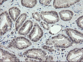 TLE1 / TLE 1 Antibody - IHC of paraffin-embedded Carcinoma of Human prostate tissue using anti-TLE1 mouse monoclonal antibody.
