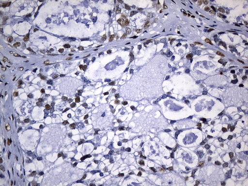 TLE1 / TLE 1 Antibody - Immunohistochemical staining of paraffin-embedded Adenocarcinoma of Human ovary tissue using anti-TLE1 mouse monoclonal antibody. (Heat-induced epitope retrieval by 1mM EDTA in 10mM Tris buffer. (pH8.0) at 120°C for 2.5 min. (1:300)