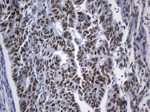 TLE1 / TLE 1 Antibody - Immunohistochemical staining of paraffin-embedded Adenocarcinoma of Human endometrium tissue using anti-TLE1 mouse monoclonal antibody. (Heat-induced epitope retrieval by 1mM EDTA in 10mM Tris buffer. (pH8.0) at 120°C for 2.5 min. (1:300)
