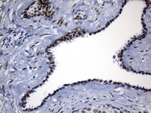TLE1 / TLE 1 Antibody - Immunohistochemical staining of paraffin-embedded Carcinoma of Human prostate tissue using anti-TLE1 mouse monoclonal antibody. (Heat-induced epitope retrieval by 1mM EDTA in 10mM Tris buffer. (pH8.0) at 120°C for 2.5 min. (1:300)