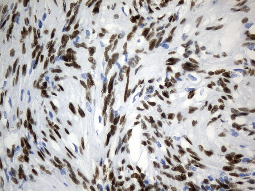 TLE1 / TLE 1 Antibody - Immunohistochemical staining of paraffin-embedded Human neurilemmoma tissue using anti-TLE1 mouse monoclonal antibody. (Heat-induced epitope retrieval by 1mM EDTA in 10mM Tris buffer. (pH8.0) at 120°C for 2.5 min. (1:300)