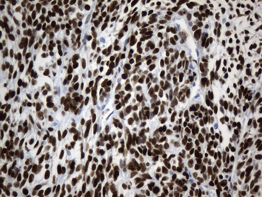 TLE1 / TLE 1 Antibody - Immunohistochemical staining of paraffin-embedded Human synovial sarcoma tissue using anti-TLE1 mouse monoclonal antibody. (Heat-induced epitope retrieval by 1mM EDTA in 10mM Tris buffer. (pH8.0) at 120°C for 2.5 min. (1:300)