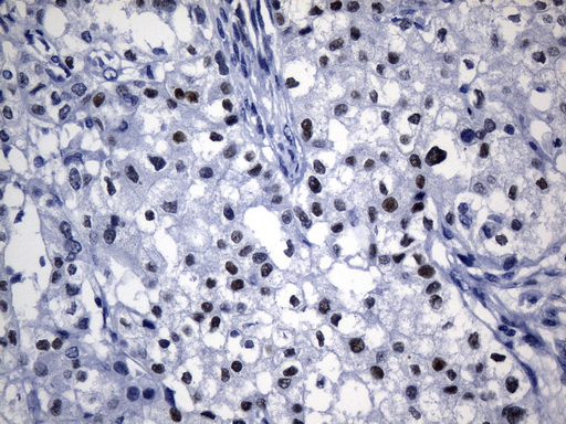 TLE1 / TLE 1 Antibody - Immunohistochemical staining of paraffin-embedded Carcinoma of Human kidney tissue using anti-TLE1 mouse monoclonal antibody. (Heat-induced epitope retrieval by 1mM EDTA in 10mM Tris buffer. (pH8.0) at 120°C for 2.5 min. (1:300)