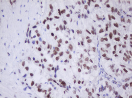 TLE1 / TLE 1 Antibody - IHC of paraffin-embedded Adenocarcinoma of Human ovary tissue using anti-TLE1 mouse monoclonal antibody.