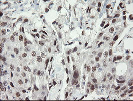 TLE1 / TLE 1 Antibody - IHC of paraffin-embedded Adenocarcinoma of Human breast tissue using anti-TLE1 mouse monoclonal antibody.