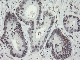 TLE1 / TLE 1 Antibody - IHC of paraffin-embedded Adenocarcinoma of Human colon tissue using anti-TLE1 mouse monoclonal antibody.