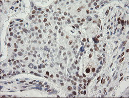 TLE1 / TLE 1 Antibody - IHC of paraffin-embedded Carcinoma of Human lung tissue using anti-TLE1 mouse monoclonal antibody.