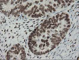 TLE1 / TLE 1 Antibody - IHC of paraffin-embedded Adenocarcinoma of Human ovary tissue using anti-TLE1 mouse monoclonal antibody.