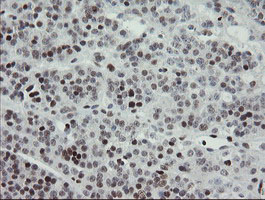 TLE1 / TLE 1 Antibody - IHC of paraffin-embedded Carcinoma of Human pancreas tissue using anti-TLE1 mouse monoclonal antibody.