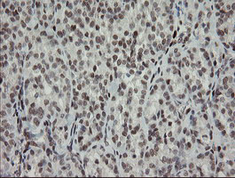 TLE1 / TLE 1 Antibody - IHC of paraffin-embedded Carcinoma of Human thyroid tissue using anti-TLE1 mouse monoclonal antibody.