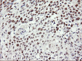 TLE1 / TLE 1 Antibody - IHC of paraffin-embedded Carcinoma of Human bladder tissue using anti-TLE1 mouse monoclonal antibody.