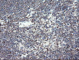 TLE1 / TLE 1 Antibody - IHC of paraffin-embedded Human lymphoma tissue using anti-TLE1 mouse monoclonal antibody.