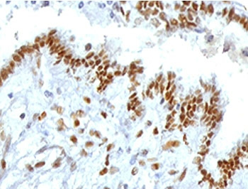 TLE1 / TLE 1 Antibody - IHC testing of FFPE human endometrial carcinoma with TLE1 antibody (clone TLEP1-1). Required HIER: boil tissue sections in pH6, 10mM citrate buffer, for 10-20 min followed by cooling at RT for 20 min.