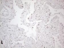 TLK2 Antibody - Immunohistochemical staining of paraffin-embedded Carcinoma of Human lung tissue using anti-TLK2 mouse monoclonal antibody. (Heat-induced epitope retrieval by 1mM EDTA in 10mM Tris buffer. (pH8.5) at 120°C for 3 min. (1:150)