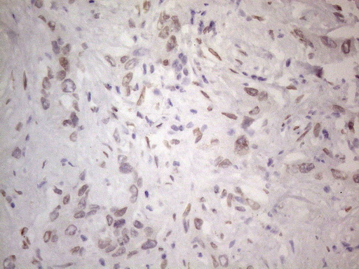 TLK2 Antibody - Immunohistochemical staining of paraffin-embedded Human liver tissue within the normal limits using anti-TLK2 mouse monoclonal antibody. (Heat-induced epitope retrieval by 1mM EDTA in 10mM Tris buffer. (pH8.5) at 120°C for 3 min. (1:150)