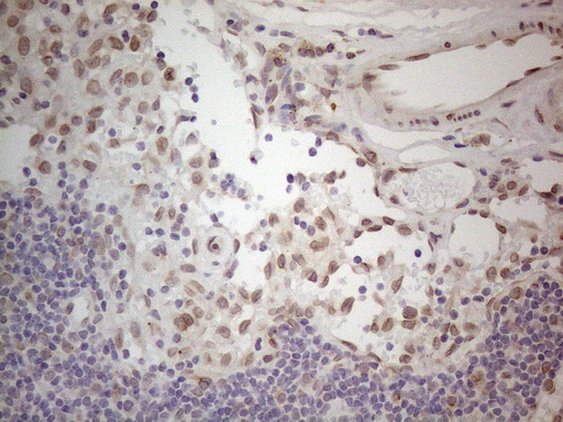 TLK2 Antibody - Immunohistochemical staining of paraffin-embedded Carcinoma of Human thyroid tissue using anti-TLK2 mouse monoclonal antibody. (Heat-induced epitope retrieval by 1mM EDTA in 10mM Tris buffer. (pH8.5) at 120°C for 3 min. (1:150)