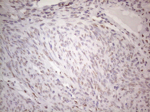 TLK2 Antibody - Immunohistochemical staining of paraffin-embedded Human endometrium tissue within the normal limits using anti-TLK2 mouse monoclonal antibody. (Heat-induced epitope retrieval by 1mM EDTA in 10mM Tris buffer. (pH8.5) at 120°C for 3 min. (1:150)