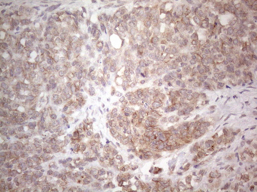 TLK2 Antibody - Immunohistochemical staining of paraffin-embedded Adenocarcinoma of Human endometrium tissue using anti-TLK2 mouse monoclonal antibody. (Heat-induced epitope retrieval by 1mM EDTA in 10mM Tris buffer. (pH8.5) at 120°C for 3 min. (1:150)