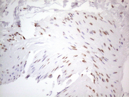 TLK2 Antibody - Immunohistochemical staining of paraffin-embedded Human lung tissue within the normal limits using anti-TLK2 mouse monoclonal antibody. (Heat-induced epitope retrieval by 1mM EDTA in 10mM Tris buffer. (pH8.5) at 120°C for 3 min. (1:150)