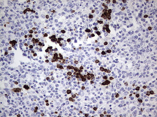 TLK2 Antibody - Immunohistochemical staining of paraffin-embedded Human tonsil within the normal limits using anti-TLK2 mouse monoclonal antibody. (Heat-induced epitope retrieval by 1 mM EDTA in 10mM Tris, pH8.5, 120C for 3min,