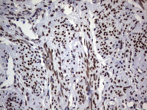 TLK2 Antibody - Immunohistochemical staining of paraffin-embedded Human endometrium tissue within the normal limits using anti-TLK2 mouse monoclonal antibody. (Heat-induced epitope retrieval by 1 mM EDTA in 10mM Tris, pH8.5, 120C for 3min,