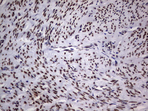 TLK2 Antibody - Immunohistochemical staining of paraffin-embedded Adenocarcinoma of Human endometrium tissue using anti-TLK2 mouse monoclonal antibody. (Heat-induced epitope retrieval by 1 mM EDTA in 10mM Tris, pH8.5, 120C for 3min,
